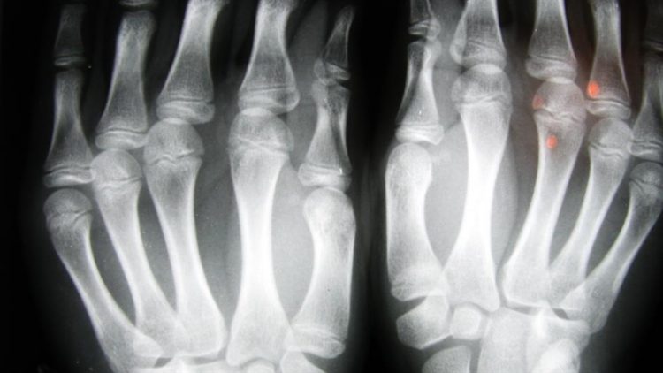 Injekcije kortikosteroida u zglob za liječenje osteoartritisa koljena | Cochrane